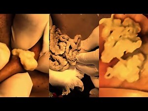 Satisfying Pimple Popping ASMR — Huge Zit & Blackhead Removal | 072