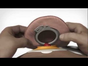 Wie versorge ich mein Dünndarmstoma?