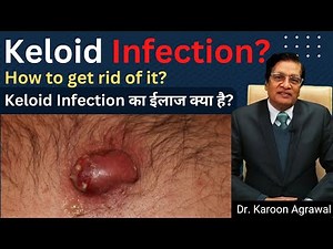 Keloid Infection? Treatment Options Explained by Dr. Karoon Agrawal