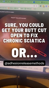 Don’t you wish that some type of pain doctor or therapist could fix sciatic nerve entrapments at the glutes, what surgeons call “deep gluteal syndrome”, without cutting people open? @adhesionreleasemethods - fixing chronic sciatica without surgery since 2023. 👉www.findanadhesionprovider.com Video courtesy of “Endoscopic Sciatic Nerve Decompression for Deep Gluteal Syndrome: Prone and Supine Approaches” by “NewYorkOrtho” on YouTube #sciaticatreatment #sciatica #sciaticarelief | Barefoot Rehabili