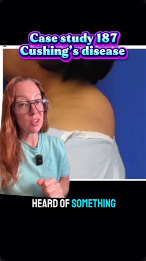 Betsy Grunch, MD | Neurosurgeon on Instagram: "Case Study 187: Cushing’s Disease Cushing’s disease is a specific form of Cushing’s syndrome caused by a pituitary adenoma that secretes excess adrenocorticotropic hormone (ACTH) — driving the adrenal glands to produce excess cortisol. 📊 Facts & Figures: • Cushing’s disease accounts for 60–70% of endogenous Cushing’s syndrome cases. • It is 3–5 times more common in women, especially between the ages of 20–40. • Average tumor size is 5 mm, often inv