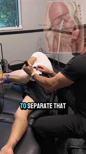 Sciatica❓😖 A trapped sciatic nerve can cause butt pain and tight hamstrings ⚡
