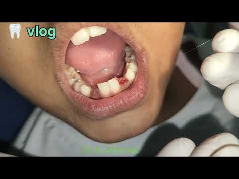 Operculectomy. Procedure how to do.