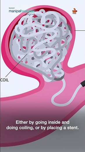 Brain Aneurysm Treatment Explained | Dr. Anurag Saxena | HCMCT Manipal Hospitals Delhi