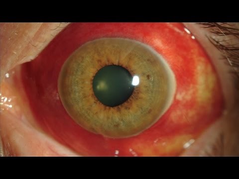 Hemorragia subconjuntival "sangre en el ojo". Centro de Oftalmología Bonafonte. Barcelona