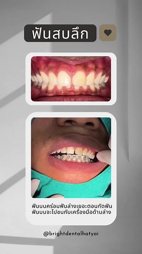 Anterior bite plate-อุปกรณ์ป้องกันฟันสบลึก #brightdentalhatyai #จัดฟันหาดใหญ่ #ไบรท์เด็นทอลหาดใหญ่ #ฟันสบลึก #ฟันคร่อม #หาดใหญ่