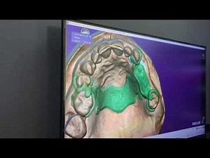 Partial Framework Design - Diseño de Prótesis Parcial Removible. Exocad/PartialCad PARTE 1