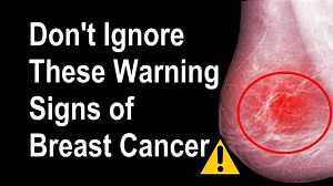 5 Early Warning Signs of Breast Cancer Many Women Ignore