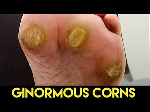 SHAVING OF THREE GINORMOUS CALLUSES ** SEE THEM TO BELIEVE IT