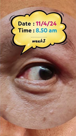 Week 3 : NO MORE RED EYES! 😍 The Retina Detachment is Finally Healing #shorts