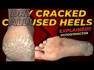 Dry Cracked Callused Heels