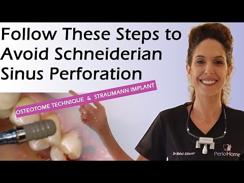 Follow These Steps To Avoid Schneiderian Membrane Perforation during Sinus Lift.