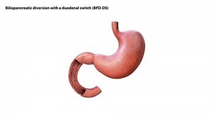 Biliopancreatic Diversion Duodenal Switch Bpd Stomach Stock Footage Video (100% Royalty-free) 3584208969 | Shutterstock