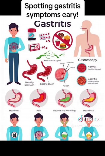 Understanding Gastritis Symptoms and Management