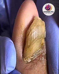 Why Americans Are Turning to Thickened Toenails For American Seniors #FootSupport #HomeNailCare #FootWellnessUSA #SafeNailCare | Alfonzo Feil