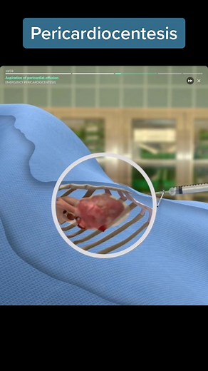 Pericardiocentesis #medicina #pericardiocentesis #fypシ #surgery #medicaltiktok