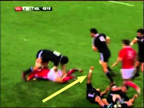 Example of tonic posturing following concussion