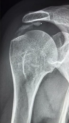 Classic case - Rotator cuff Calcific tendinopathy on plain radiograph #radiology #calcifictendinosis