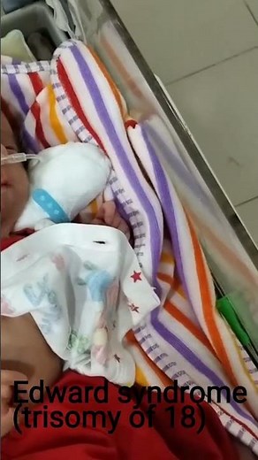 Edward syndrome features|Syndrome in neonates|Trisomy 18|