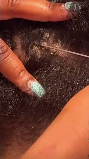 Dandruff Removal