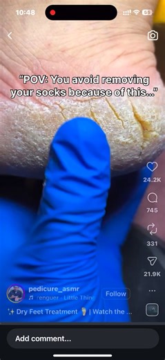 Tired of rough heels or cracked feet? Your at-home pedicure fix is finally here 💙 Meet the Skince Electric Callus Remover Kit—a waterproof, gentle, and powerful tool that transforms dry, hard skin into soft, smooth feet in minutes. 👣 3 interchangeable rollers for every skin type 🚿 IPX7 waterproof — use it in the shower ⚡ Adjustable speeds (2000–2500 RPM) 💡 Blue mood light for a premium feel 🔌 USB rechargeable 🎁 Perfect gift for your loved ones 🛡️ 2-Year Warranty Give your feet the care th