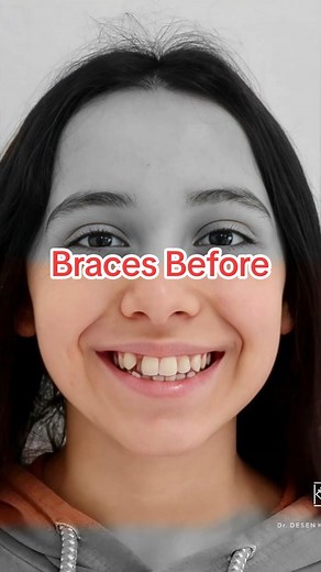 Braces before and after. Change your smile #braces #orthodontist #niengrang #dentist
