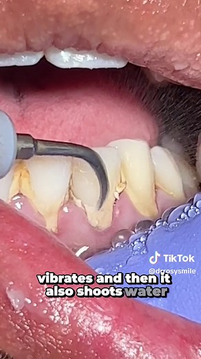 Deep Cleaning Process: Teeth Cleaning and Gum Infection Removal