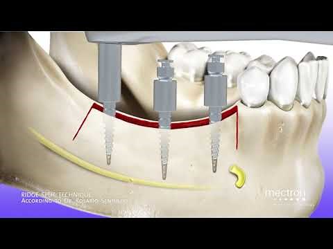 Como fazer Split Crest – Técnica de aumento da crista óssea (Ridge Split)
