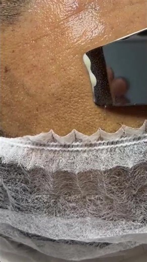 Deep Pore Cleansing ASMR | Ultrasonic Skin Scrubber Extraction Tutorial #neat #wigsandbeauty