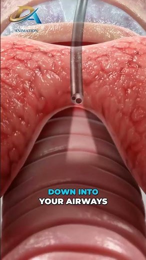Bronchoscopy (3D Animation)
