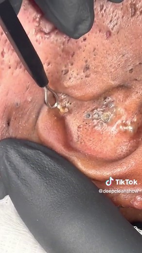Ear completely blocked by blackheads 🫣 IG minkology_101_ #satisfying #satisfyingvideo #ear #blackheads #pimplepop #asmr #cosmetics #beautyhacks #beautyproducts