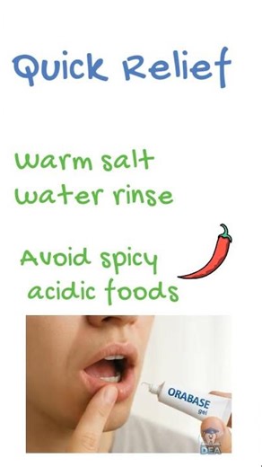 Mouth Ulcer FIX IT! 💥