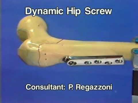DHS , Dynamic Hip Screw - Surgical Technique