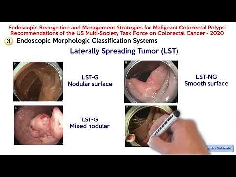 Endoscopic Recognition and Management Strategies for Malignant Colorectal Polyps