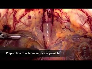 Laparoscopic Radical Prostatectomy - Dissecting the Anterior Surface • Video • MEDtube.net