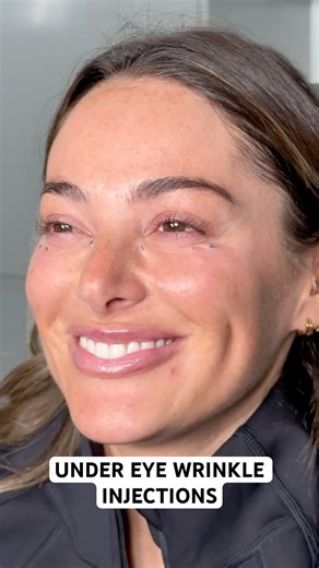 Can anti wrinkle injections actually get rid of under-eye lines?