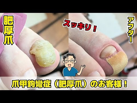 分厚くて切れない爪【高齢者の爪切りケア】