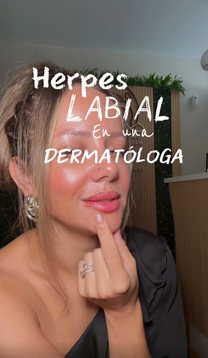 Herpes Labial: Infección Viral Crónica y Tratamiento