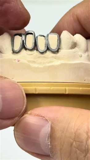 Teeth Reduction guide for future crowns!