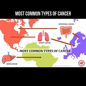 Most common types of cancer #oncology #cancer | About health and science in simple words | Facebook