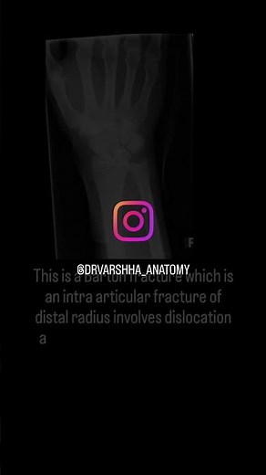 🦴 Barton’s Fracture Explained! 🦴A fracture of the distal radius # fracture xray# dr Varshha anatomy