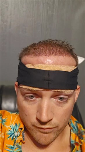 Taking control: What it's like to finally do something about hair loss. 👇🏽 For years, Jacob watched his hair get thinner and thinner. The confidence was fading, and he knew shaving it all off wasn't the answer he wanted. So he made a decision that would change everything: a hair transplant at Shah Plastic Surgery. Jacob's honest thoughts before surgery: 💬 "I was nervous — I'd never had surgery before" 💬 "I was worried about scarring and the cost" 💬 "I was hesitant because results take so lo