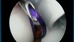 Surgical Approaches to Coronoid & Radial Head Fractures of the Elbow