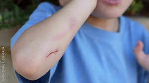 Child shows fresh elbow scrape outdoors, revealing red abrasion, sensitive skin, and typical childhood injury moment that requires simple first aid. Safety education, healthcare, parenting visuals.
