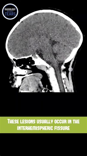 Case of the Day - Corpus callosum lesions #radiology