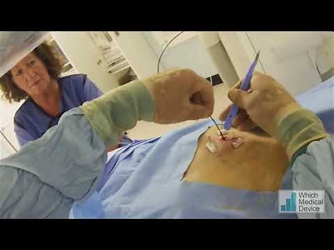 Primary Button Gastrostomy