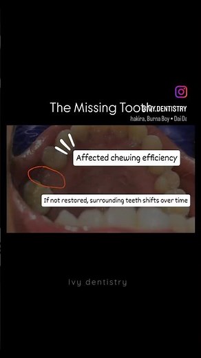 Dental implant Step-by-step