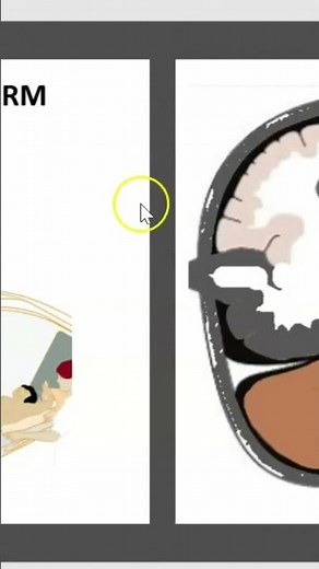 Brain Herniation: Diagnosis, Complications, and Vision Loss #shorts