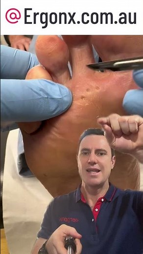 Docpods Podiatrist Removes Corn: Quick & Easy Solution #Corns #FootCare