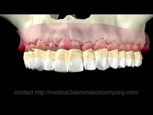 periodontal disease Periodontitis 3d medical animation company studio 3d visualization health care s